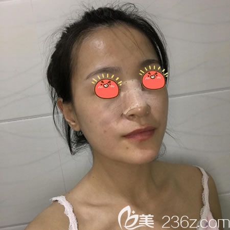 紹興藝美剛做完假體隆鼻的<span style= 紹興藝美剛做完假體隆鼻的<span style=