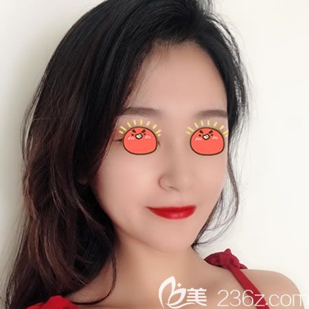 過完年在紹興藝美做的硅膠假體隆鼻手術(shù),現(xiàn)在把恢復(fù)3個月效果和價格分享給大家