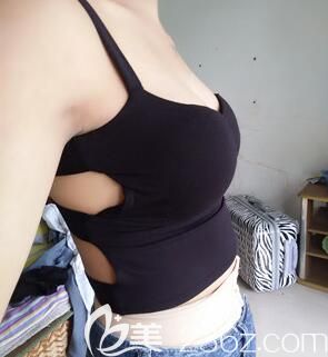 南寧隆胸哪家醫(yī)院好?寶媽在華美整形做自體脂肪豐胸同時(shí)腰腹部也吸脂塑形啦