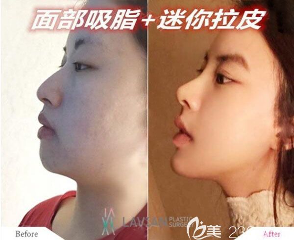 韓國拉菲安迷你拉皮手術(shù)對比照片