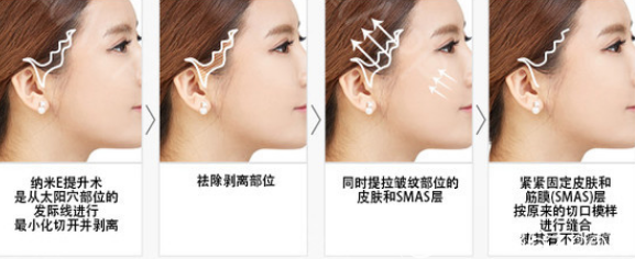 韓國拉菲安整形醫(yī)院拉皮手術(shù)過程示意圖
