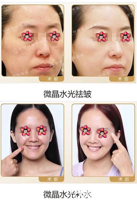 醫(yī)院余洪斌微晶水光美膚案例 醫(yī)院余洪斌微晶水光美膚案例