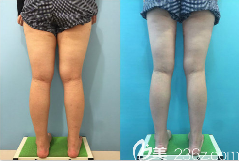韓國G皮膚<!--<i data=20240703-sp></i>-->腿吸脂塑形手術(shù)案例效果對比圖 韓國G皮膚<!--<i data=20240703-sp></i>-->腿吸脂塑形手術(shù)案例效果對比圖