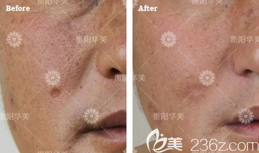 貴陽華美祛疤靠譜嗎