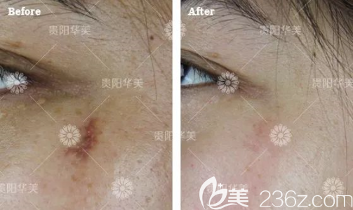 貴陽華美祛疤效果好不好