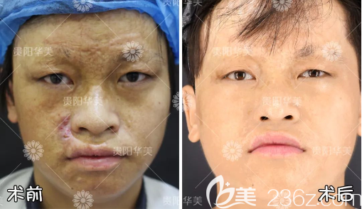 貴陽華美祛疤真人案例