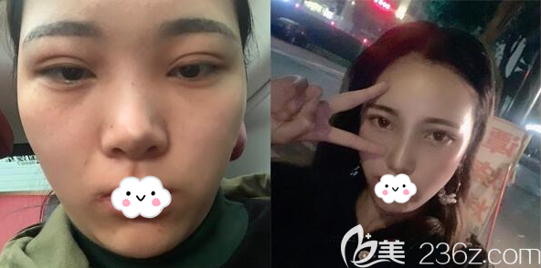 成都成美李靜鼻綜合術(shù)后15天對(duì)比照片 成都成美李靜鼻綜合術(shù)后15天對(duì)比照片