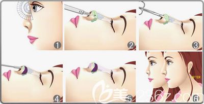 聽楊偉醫(yī)師說隆鼻手術(shù)的切口在哪