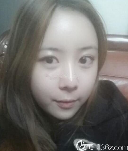 韓國遇見美李承燦骨膜提升吸引我做輪廓 術(shù)后一年了過來說說情況