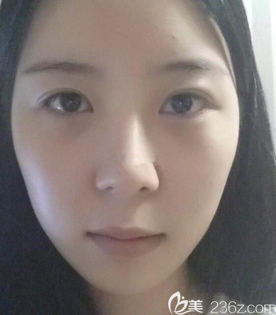 韓國遇見美李承燦做輪廓怎么樣