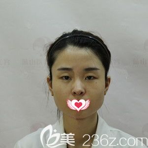 在保定藍(lán)山做雙眼皮術(shù)前是單眼皮 在保定藍(lán)山做雙眼皮術(shù)前是單眼皮