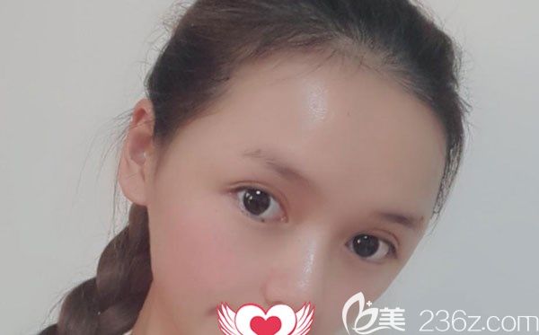 自體脂肪填充太陽穴第7天拆線沒有感到疼痛 自體脂肪填充太陽穴第7天拆線沒有感到疼痛