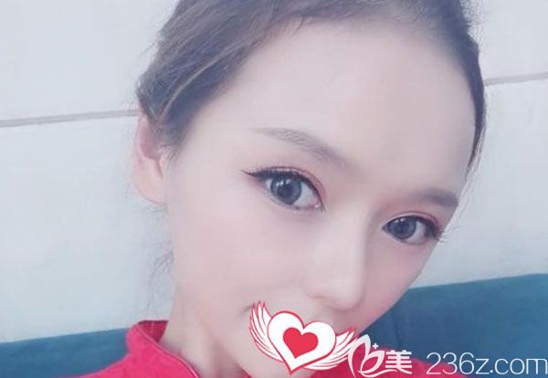 脂肪移植填充太陽穴20天脂肪存活率比較高 脂肪移植填充太陽穴20天脂肪存活率比較高