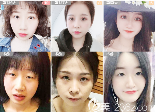 深圳米蘭柏羽黎慧娟醫(yī)生做的雙眼皮案例