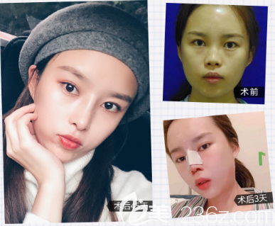 深圳米蘭柏羽黎慧娟醫(yī)生隆鼻手術案例