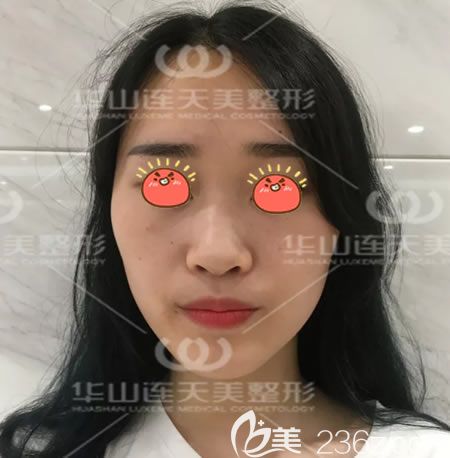 杭州連天美做肋骨鼻手術前 杭州連天美做肋骨鼻手術前