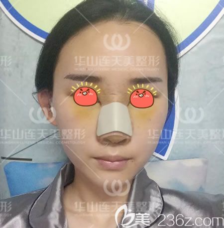 杭州連天美膨體隆鼻即刻效果 杭州連天美膨體隆鼻即刻效果