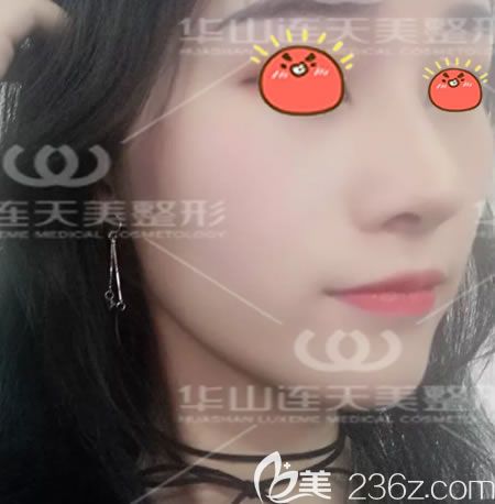 杭州連天美<!--<i data=20240703-sp></i>-->隆鼻案例 杭州連天美<!--<i data=20240703-sp></i>-->隆鼻案例