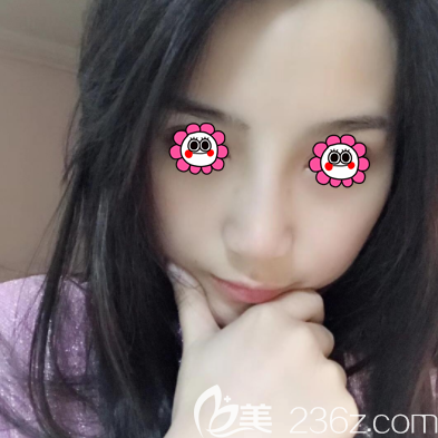 張曉亮醫(yī)生給我做假體隆鼻半個月效果