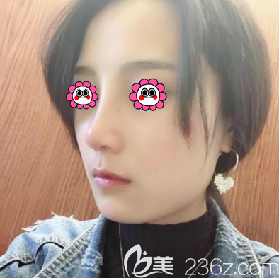 在北京壹加壹做隆鼻第36天樣子