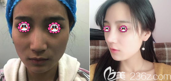 北京壹加壹隆鼻前后對比效果