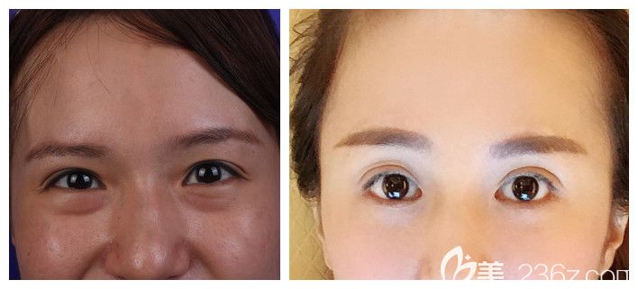 劉駿主任內(nèi)切祛眼袋+割雙眼皮術(shù)后案例展示 劉駿主任內(nèi)切祛眼袋+割雙眼皮術(shù)后案例展示