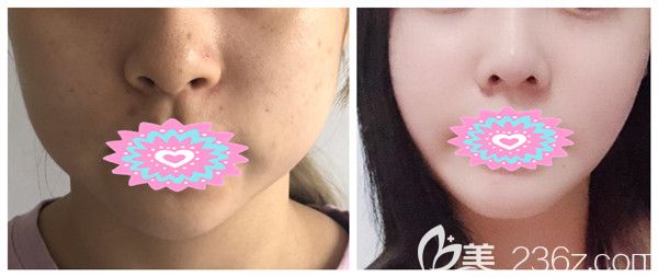 劉駿醫(yī)生瘦臉除皺瘦臉對(duì)比圖 劉駿醫(yī)生瘦臉除皺瘦臉對(duì)比圖