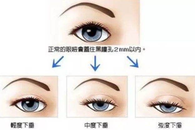 上瞼下垂的分類 上瞼下垂的分類