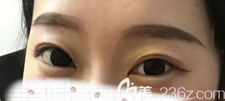 包頭葉子整形醫(yī)院割雙眼皮前 包頭葉子整形醫(yī)院割雙眼皮前