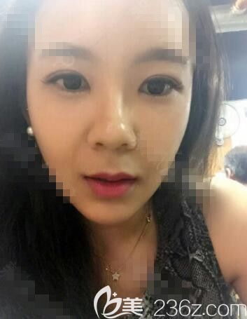 記錄韓國(guó)JK整形脂肪填充埋線(xiàn)雙眼皮開(kāi)前眼角一個(gè)月的經(jīng)歷