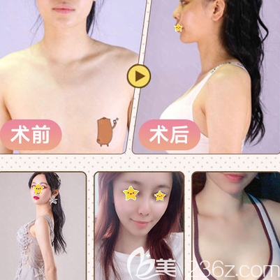 復合隆胸的案例圖