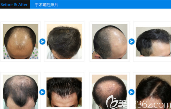 韓國JP植發(fā)醫(yī)院男士頭發(fā)種植<span style=