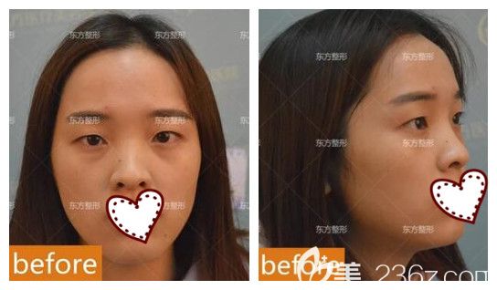 我在南寧東方整形做眼鼻部整形前 我在南寧東方整形做眼鼻部整形前