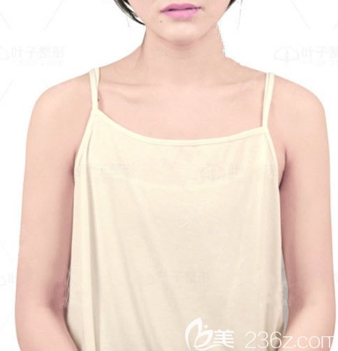 包頭葉子整形醫(yī)院假體隆胸前 包頭葉子整形醫(yī)院假體隆胸前