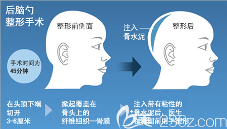 韓國雕刻骨水泥填充后腦勺過程 韓國雕刻骨水泥填充后腦勺過程