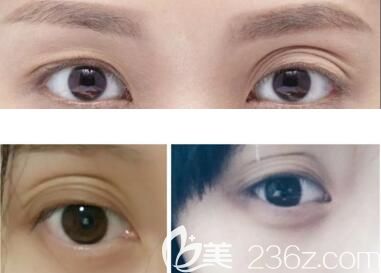 上眼皮松弛分層怎么辦？如何改善？