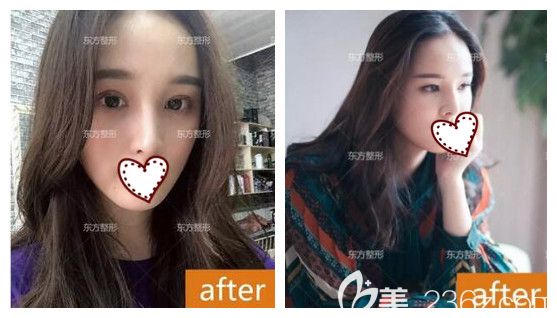  原本只是找南寧東方整形院長做肋軟骨鼻綜合隆鼻,面診后又加了全切雙眼皮