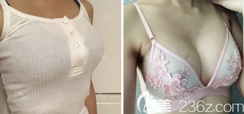 在韓國(guó)瑪博爾做假體隆胸手術(shù)后1個(gè)月 在韓國(guó)瑪博爾做假體隆胸手術(shù)后1個(gè)月