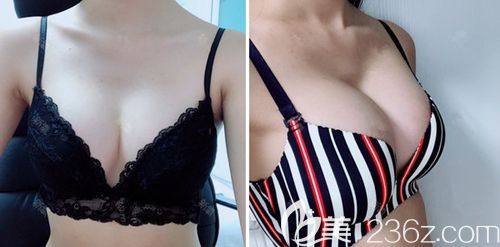 在韓國(guó)瑪博爾做假體隆胸手術(shù)后3個(gè)月 在韓國(guó)瑪博爾做假體隆胸手術(shù)后3個(gè)月