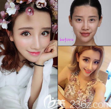 隆鼻術(shù)前術(shù)后對比照片