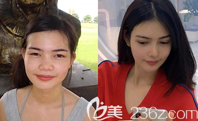 韓國樂于麗顏金范鎮(zhèn)院長韓式隆鼻案例效果對比圖