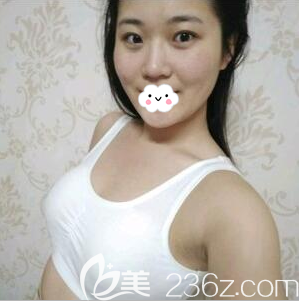 自體脂肪豐胸術(shù)后5天恢復(fù)照片