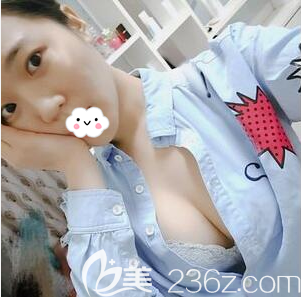成都賴明忠脂肪隆胸術(shù)后15天效果圖