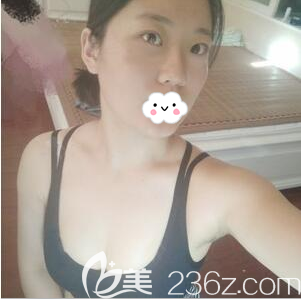 成都成美賴明忠自體脂肪豐胸術(shù)后效果
