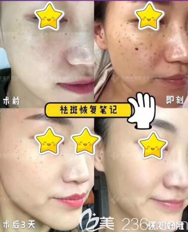 海南華美整形超皮秒祛斑真人前后效果對比照片