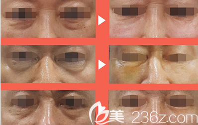 韓國815抗衰老眼袋治療前后照片