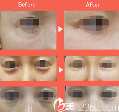 韓國815抗衰老眼袋治療前后照片