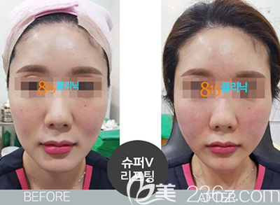韓國815抗衰老面部提升案例效果前后對(duì)比圖