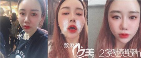 韓國寶士麗玻尿酸填充真人案例 韓國寶士麗玻尿酸填充真人案例