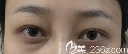 去贛州韓美整形做不開刀去眼袋前照片 去贛州韓美整形做不開刀去眼袋前照片